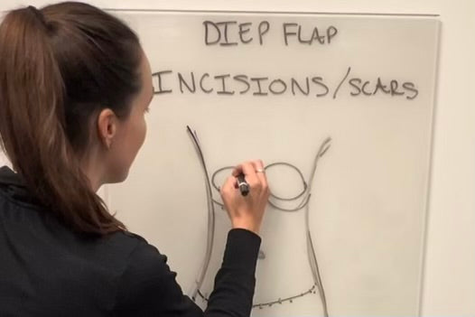 DIEP Flap Reconstruction: An Overview